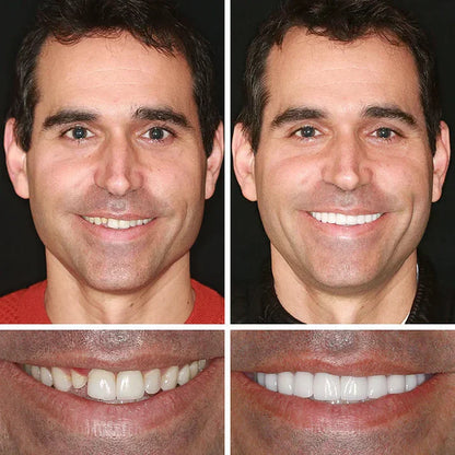 🌎Ends Today: 70% OFF! ⏰ Custom-Fit Full Functional Dentures Make you more confident