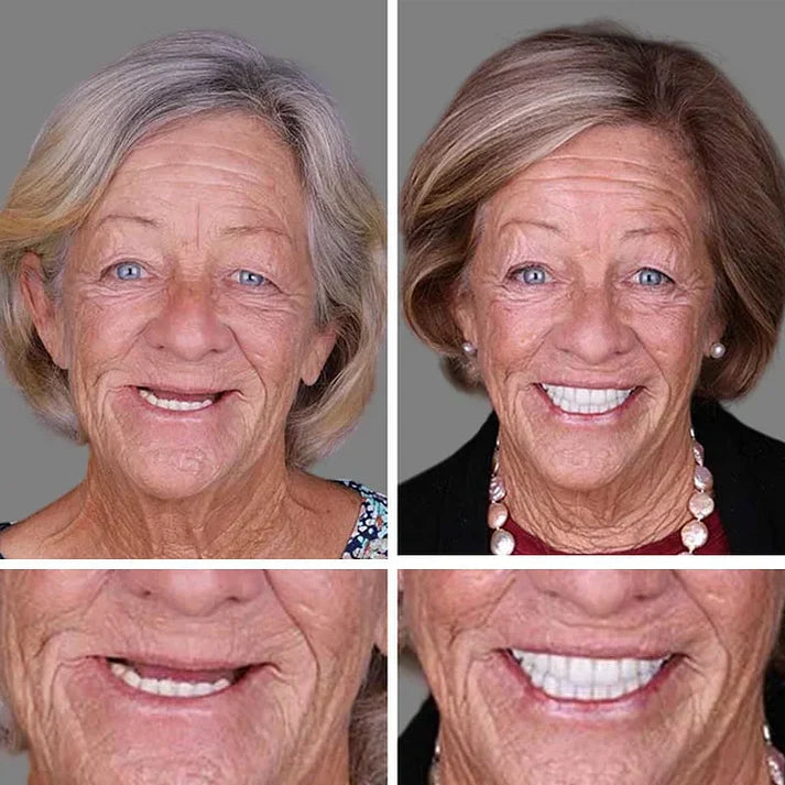 🌎Ends Today: 70% OFF! ⏰ Custom-Fit Full Functional Dentures Make you more confident